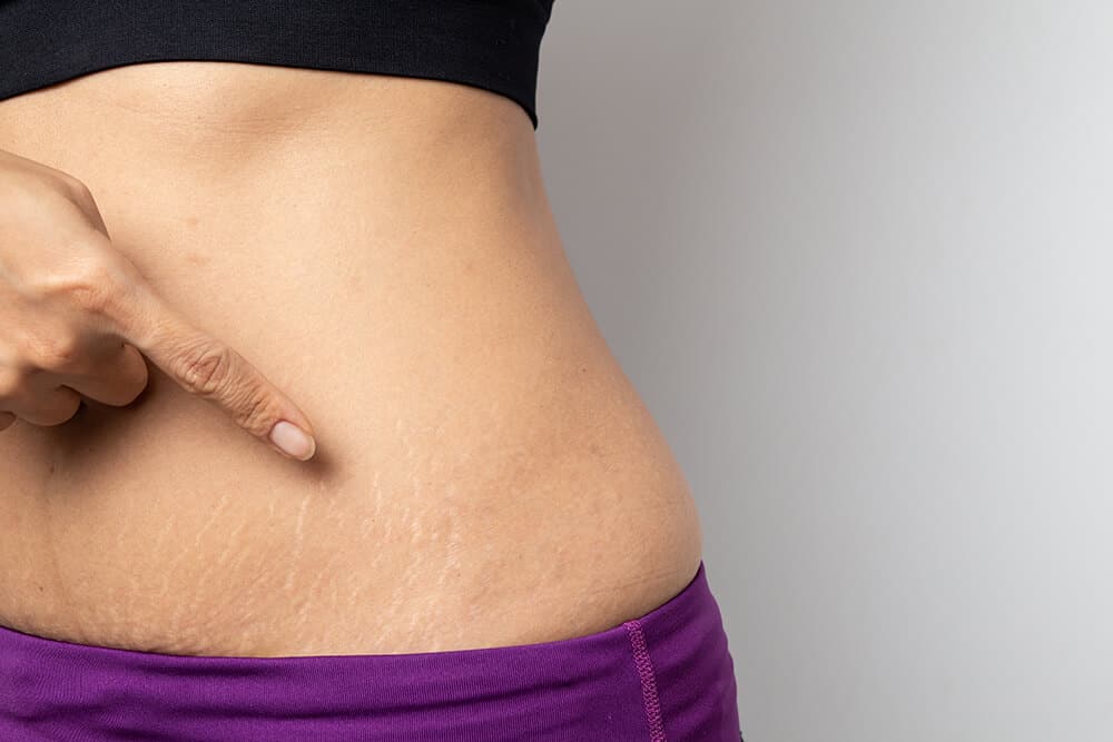 How to get rid of stretch marks