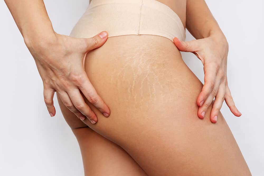 How to get rid of stretch marks